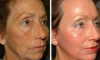2 enkle måter å fjerne rynker i ansiktet hjemme uten kirurgi og uten skjønnhets