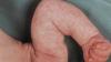 "Marmor" hud hos babyer: norm eller patologi? Nevrolog svarer