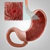 Gastritt, eller erosjon av magen: de viktigste symptomene, behandling, kosthold