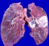 Lungekreft: hvordan å ikke gå glipp av starten av sykdommen?