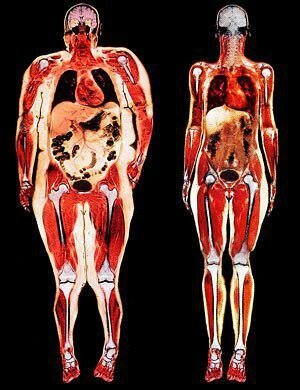 Venstre - bare visceral fedme. Alle organer overøst med fett.
