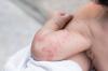 Hvordan behandle atopisk dermatitt hos barn
