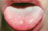 Hva gjør den hvite plakk på tungen?