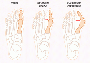Hvordan fjerne et bein i foten