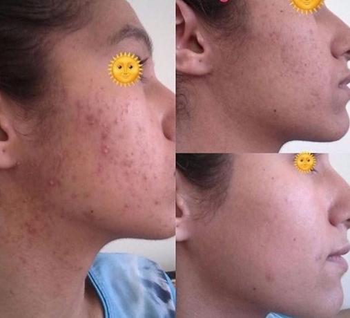 enzymer Acne Treatment