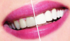 Hvordan å bleke tennene hjemme? dental råd.
