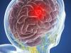 Hjernesvulst: 5 symptomer som ikke kan ignoreres