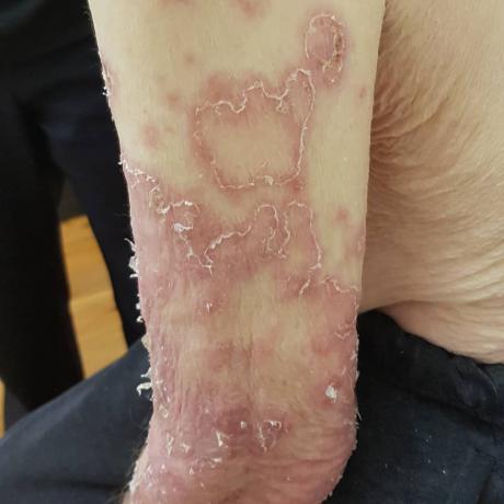 Her er pellagra. Bilder av pasienten fra amerikanske sykehjem