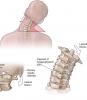 4 grunnleggende øvelser for cervical ryggraden vil bidra til å glemme smerten og Osteochondrose!