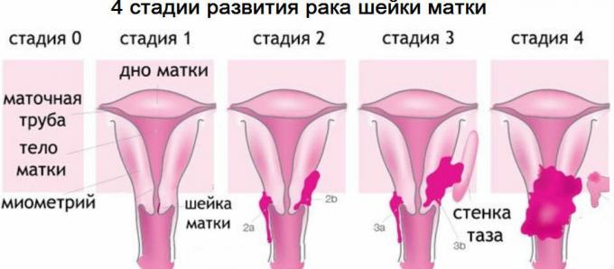 4 stadier av livmorhalskreft
