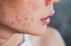 Slik rydder du opp huden din etter sommeren: hjemme- og salongbehandlinger