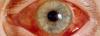 Den akutte glaukom: hva det er, hvordan å behandle?