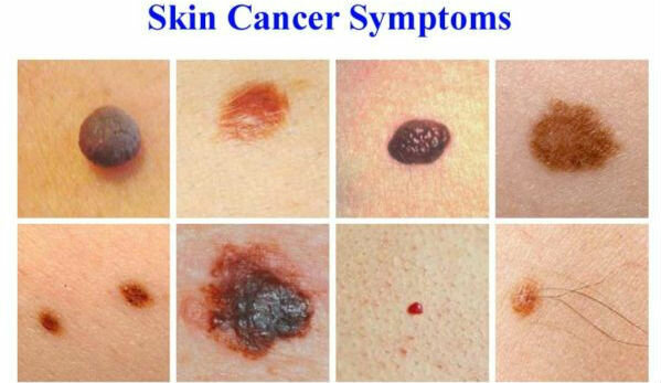 Symptomer på hudkreft