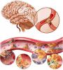 Cerebral aterosklerose: Årsaker