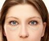 Hvordan bli kvitt uten kirurgi, en brokk og nedre øyelokk øye poser